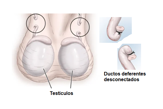 vasectomia