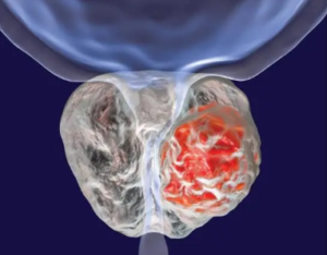 biopsia de prostata
