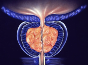 exame de prostata
