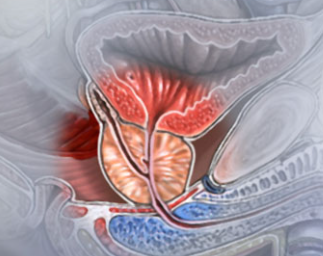 prostata aumentada causa impotencia