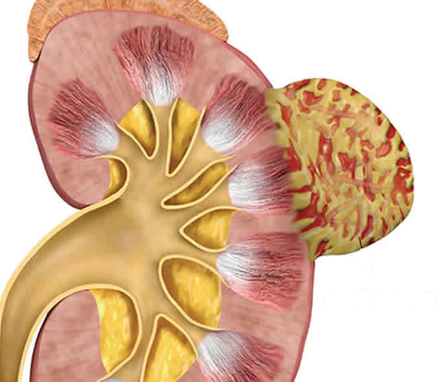angiomiolipoma