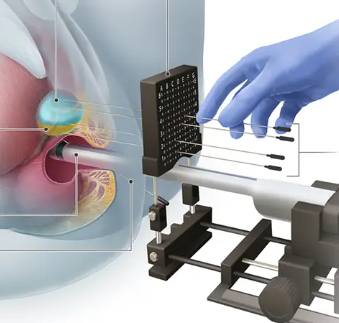 biopsia transperineal de próstata
