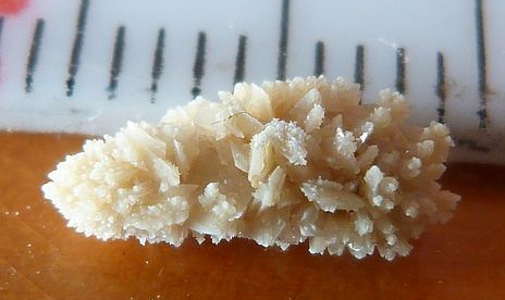 cirurgia a laser pedra nos rins