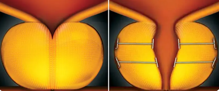 urolift preço