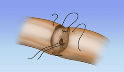 vasectomia é reversível