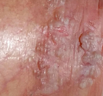 cauterização hpv