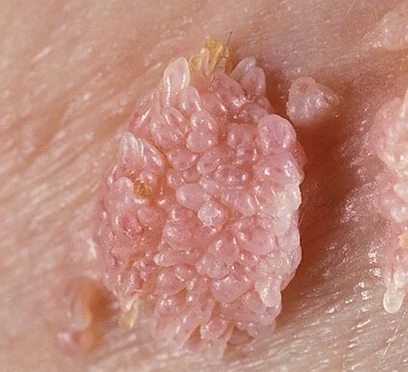 hpv