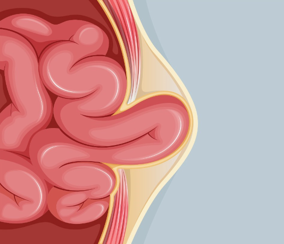 O que fazer no pós-operatório da hérnia inguinal - Hernia Clinic