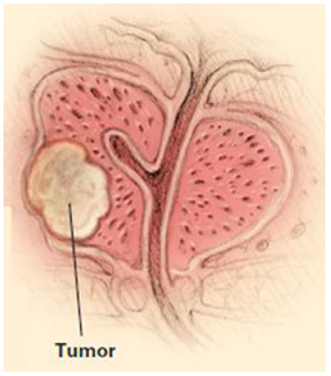 o que causa o cancer de prostata