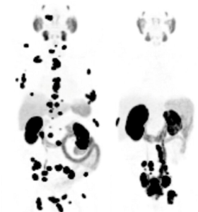 pet psma