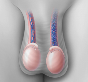 varicocele