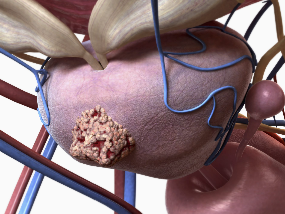 biopsia de prostata como é feita