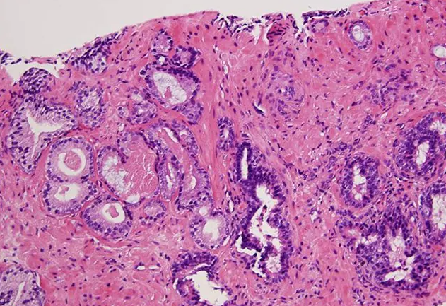 como interpretar os resultados da biópsia de próstata