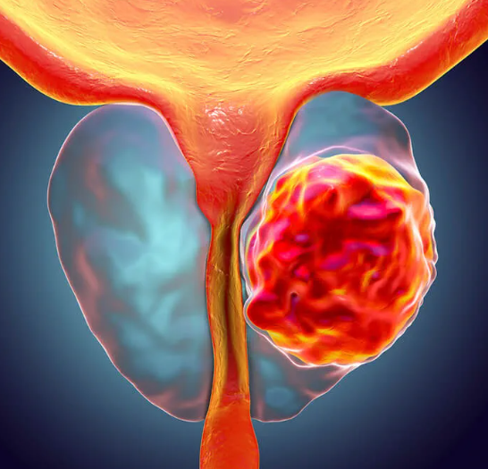 prostatectomia radical