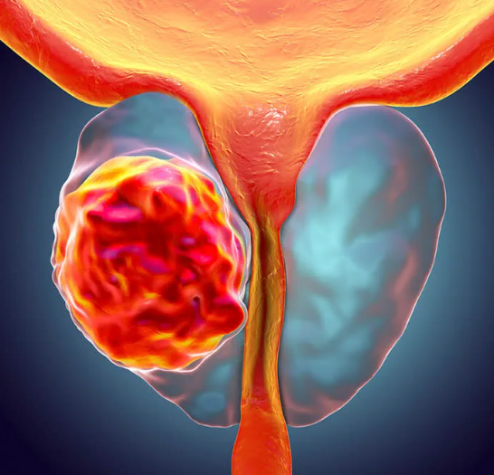 prostatectomia o que é