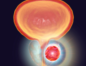 prostatectomia robotica