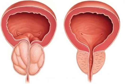 prostatectomia transvesical