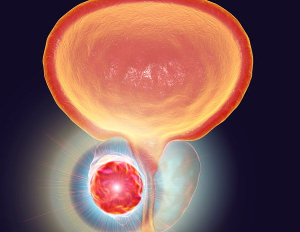 qual o valor do psa após prostatectomia radical