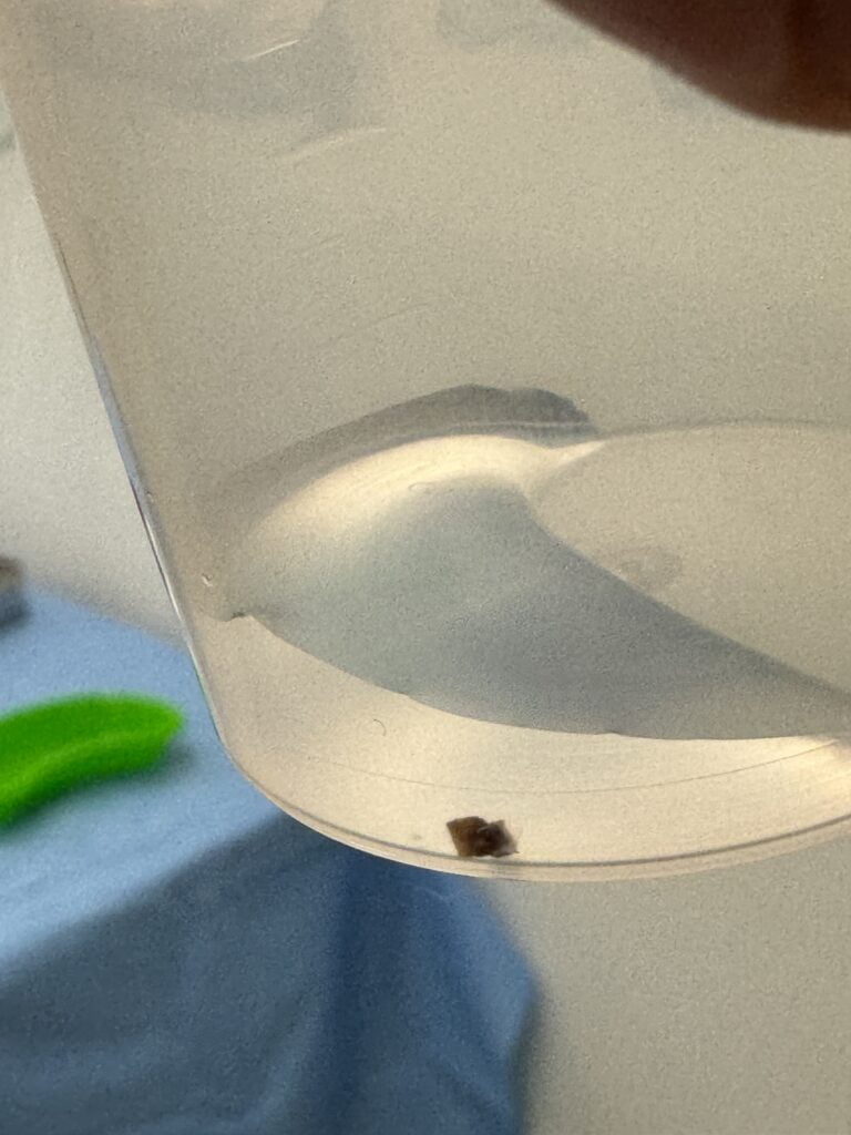 como eliminar pedra no rim rápido