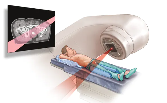 radioterapia no cancer de prostata
