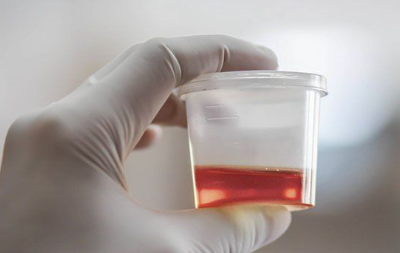 o que causa hemácias na urina