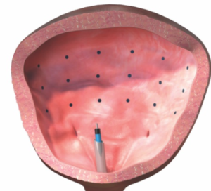 botox para incontinencia urinaria