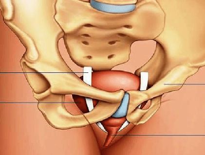 cirurgia de sling feminino