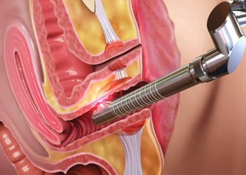 laser vaginal