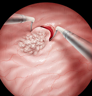 como retirar um nodulo na bexiga
