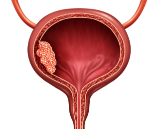 como é o procedimento de raspagem na bexiga