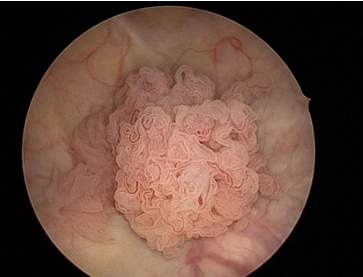 sintomas de cancer na bexiga
